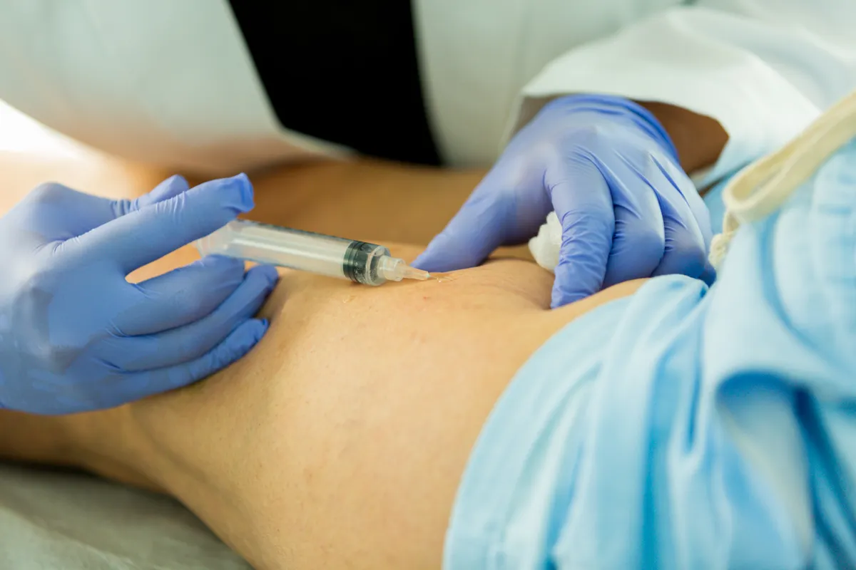 Paciente recibiendo tratamiento de escleroterapia