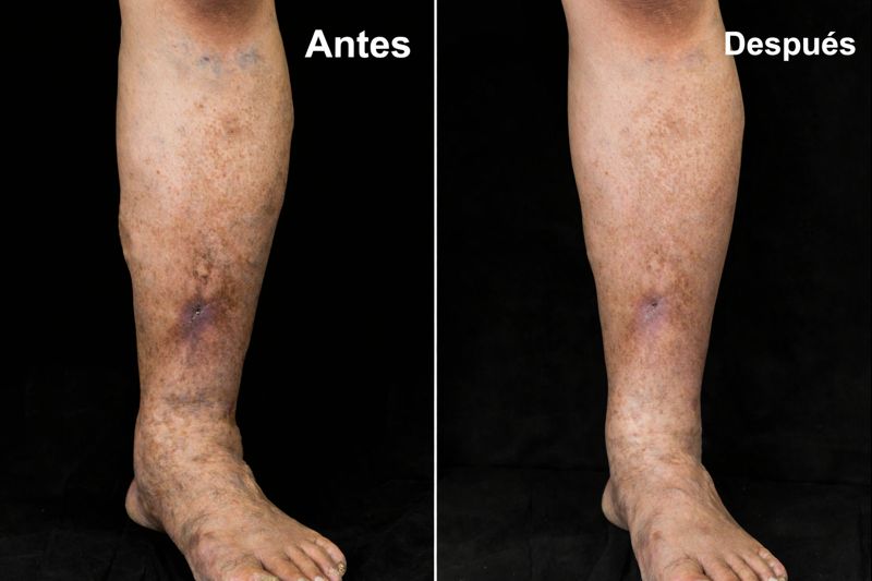 Juan Carlos Cervantes, paciente tratado con ClariVein
